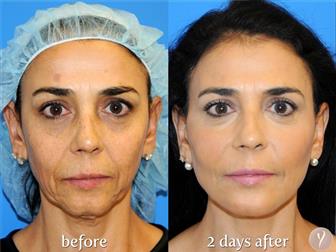    - 30-Minute Non-Surgical Facelift,    , 36950757  